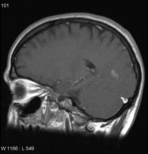 File:Neurosarcoidosis (Radiopaedia 10930-17204 Sagittal T1 C+ 6).jpg