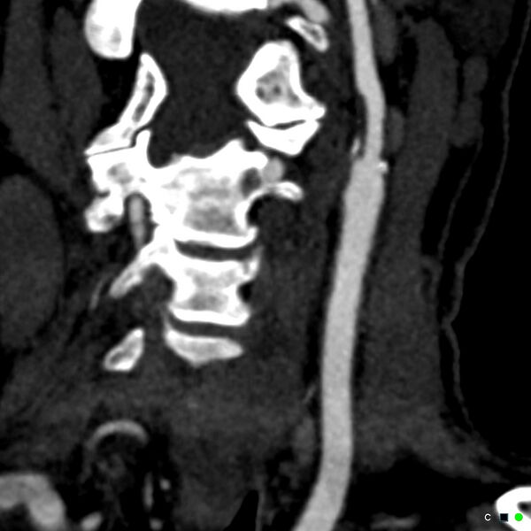 File:Non-occlusive intraluminal internal carotid artery thrombus (Radiopaedia 37751-39658 C 3).jpg
