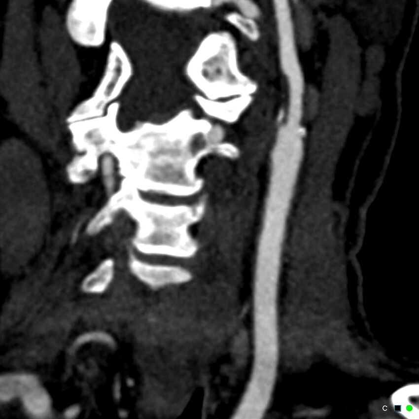 Non-occlusive intraluminal internal carotid artery thrombus (Radiopaedia 37751-39658 C 3).jpg