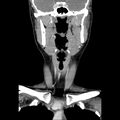 Normal CT of the neck (Radiopaedia 14575-14500 Coronal C+ 23).jpg