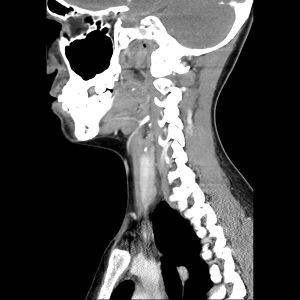 File:Normal CT of the neck (Radiopaedia 14575-14500 Sagittal C+ 33).jpg