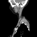 Normal CT of the neck (Radiopaedia 14575-14500 Sagittal C+ 44).jpg