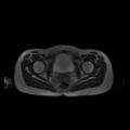 Normal MRI abdomen in pregnancy (Radiopaedia 88001-104541 Axial T2 67).jpg