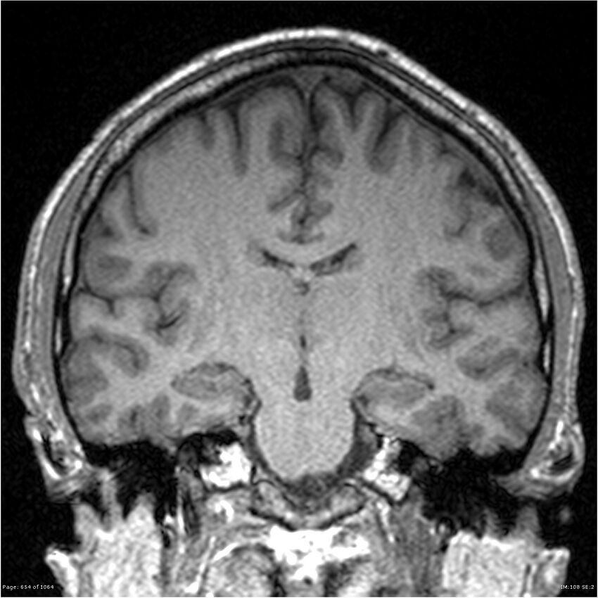 Normal brain MRI (non-focal epilepsy protocol) (Radiopaedia 38571-40700 Coronal T1 53).jpg
