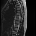 Normal cervical and thoracic spine MRI (Radiopaedia 35630-37156 G 8).png