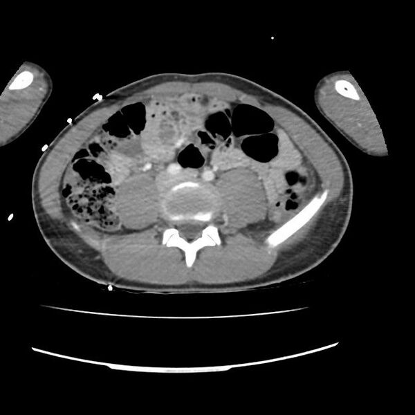 File:Normal dual-phase trauma CT chest,abdomen and pelvis (Radiopaedia 48092-52899 A 83).jpg