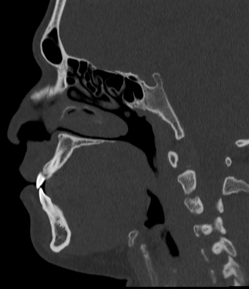 Normal facial bone CT (Radiopaedia 88742-105476 Sagittal bone window 80).jpg