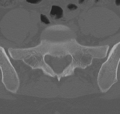Normal lumbar spine CT (Radiopaedia 46533-50986 Axial bone window 67).png