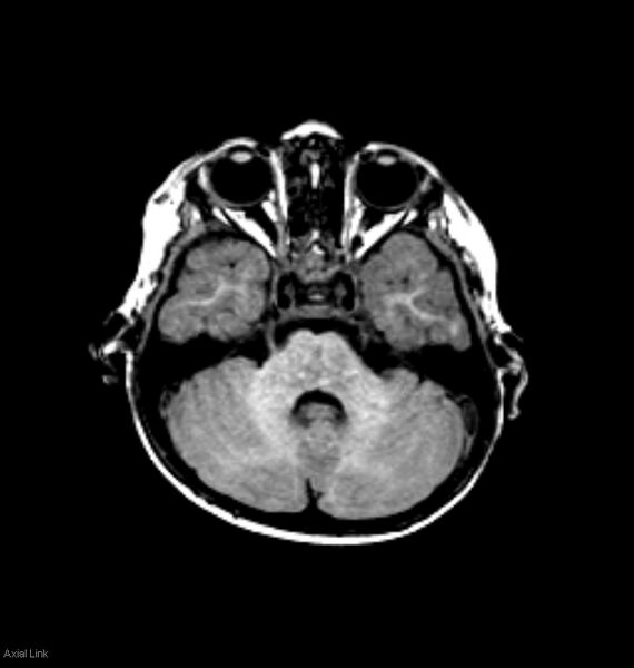 File:Normal myelination 2 year old (Radiopaedia 6815-7983 Axial T1 2).jpg