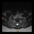 Normal spine MRI (Radiopaedia 77323-89408 Axial T2 29).jpg