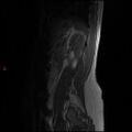 Normal spine MRI (Radiopaedia 77323-89408 Sagittal T1 14).jpg