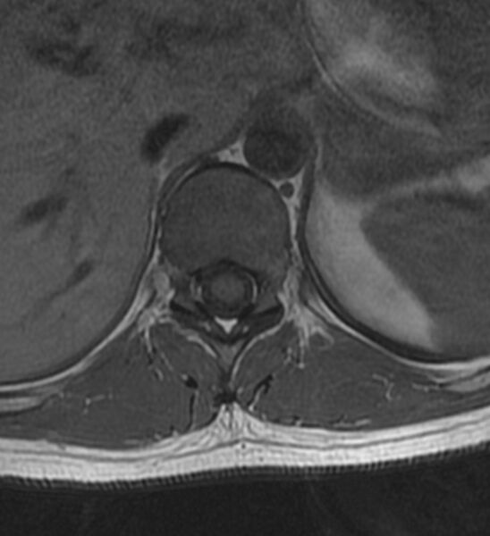 File:Normal thoracic spine MRI (Radiopaedia 41033-43781 Axial T1 20).jpg