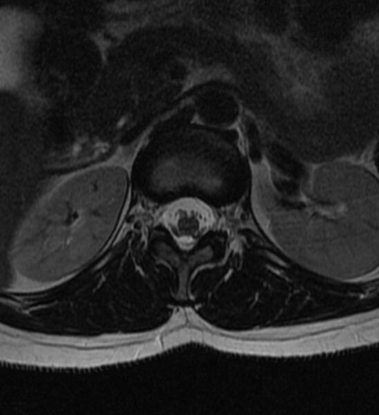 File:Normal thoracic spine MRI (Radiopaedia 41033-43781 Axial T2 32).jpg
