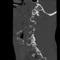Normal trauma cervical spine (Radiopaedia 41017-43760 Sagittal bone window 7).png