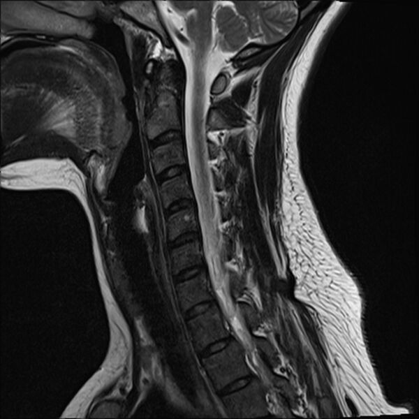 File:Normal trauma cervical spine MRI (Radiopaedia 32130-33071 Sagittal T2 6).jpg