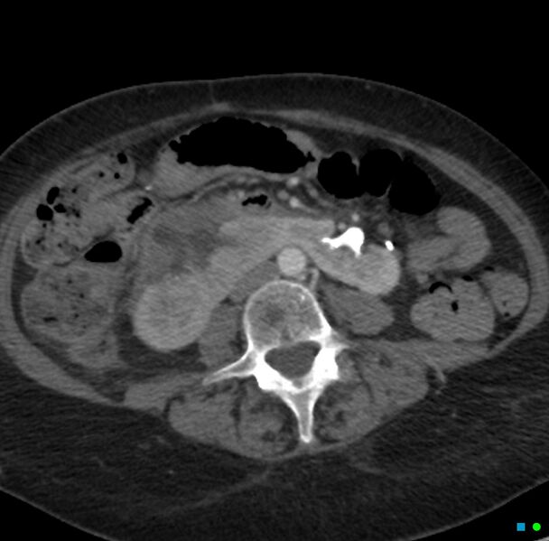 File:Obstructed infected horseshoe kidney (Radiopaedia 18116-17898 B 19).jpg
