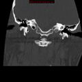 Occipital condyle fracture (Radiopaedia 18366-18208 Coronal bone window 4).jpg