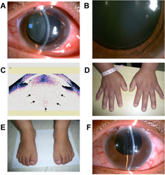 a) Small lens, b) suspensory ligaments, c)lens is microspherophakic, d) & e), short toes/fingers ,f) phacoemulsification and intraocular lens implantation.