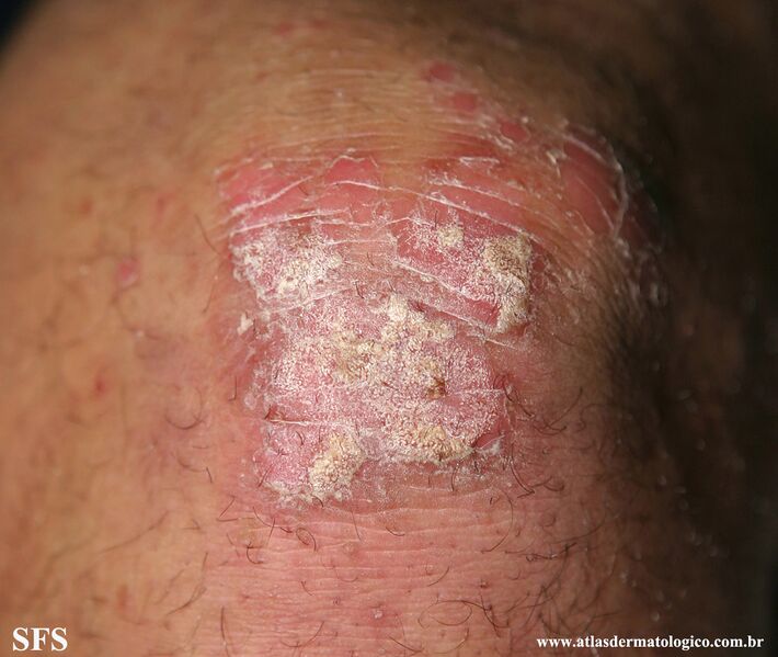 File:Psoriasis (Dermatology Atlas 132).jpg