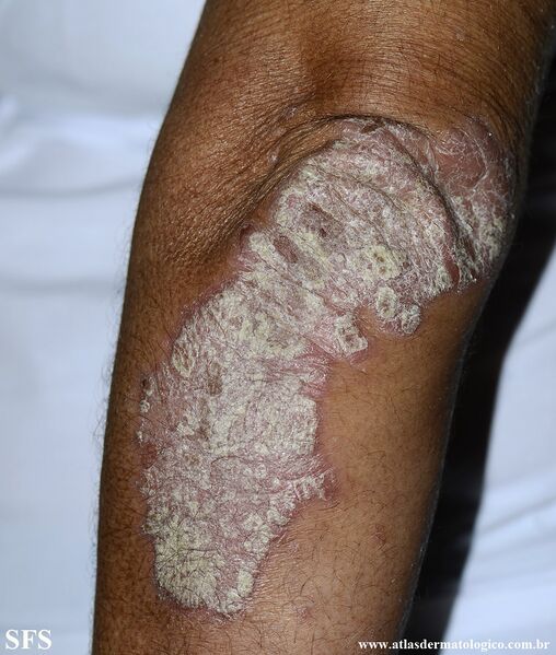 File:Psoriasis (Dermatology Atlas 159).jpg