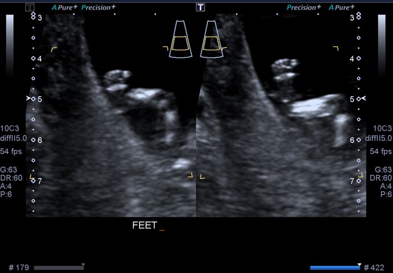 File:1st trimester nuchal-morphology ultrasound (Radiopaedia 44706-48477 General anatomy and NT 30).jpg