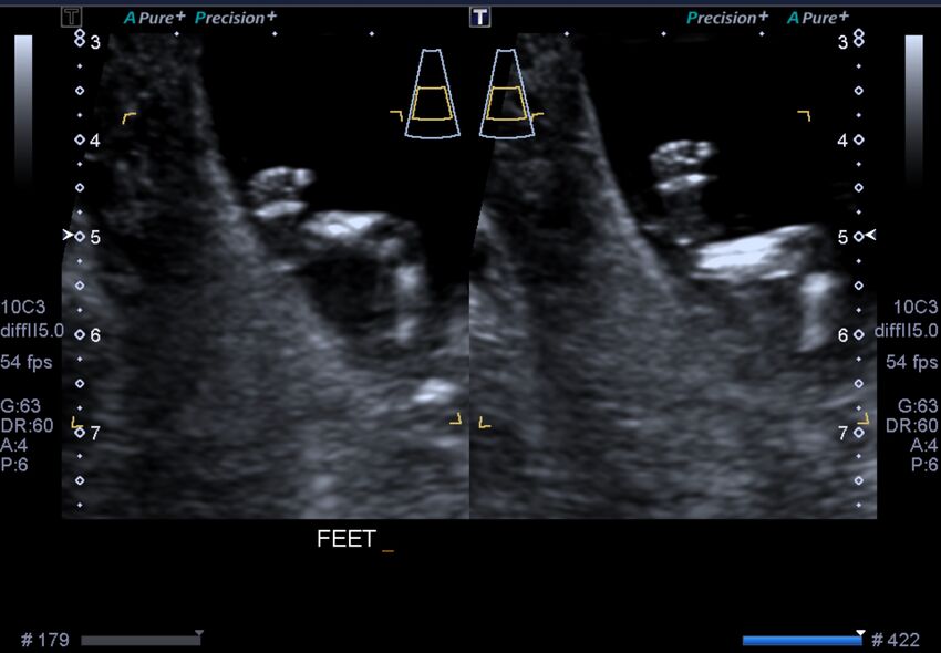 1st trimester nuchal-morphology ultrasound (Radiopaedia 44706-48477 General anatomy and NT 30).jpg