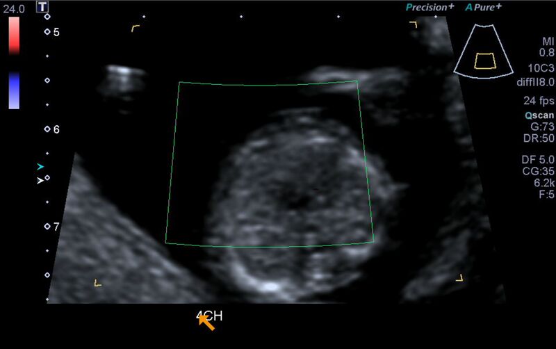 File:1st trimester nuchal-morphology ultrasound (Radiopaedia 44706-48477 Heart views cine with colour 80).jpg