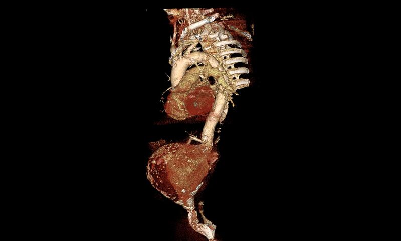 File:Abdominal aortic aneurysm- extremely large, ruptured (Radiopaedia 19882-19921 3D 6).jpg