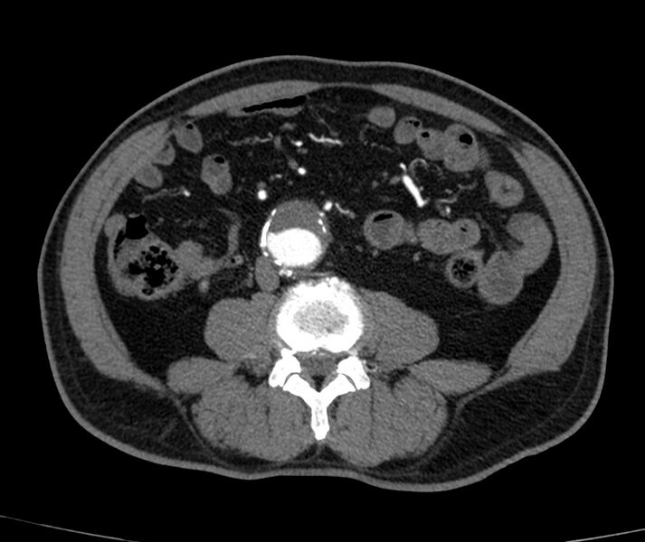 File:Abdominal aortic aneurysm (Radiopaedia 22421-22458 C+ arterial phase 52).jpg