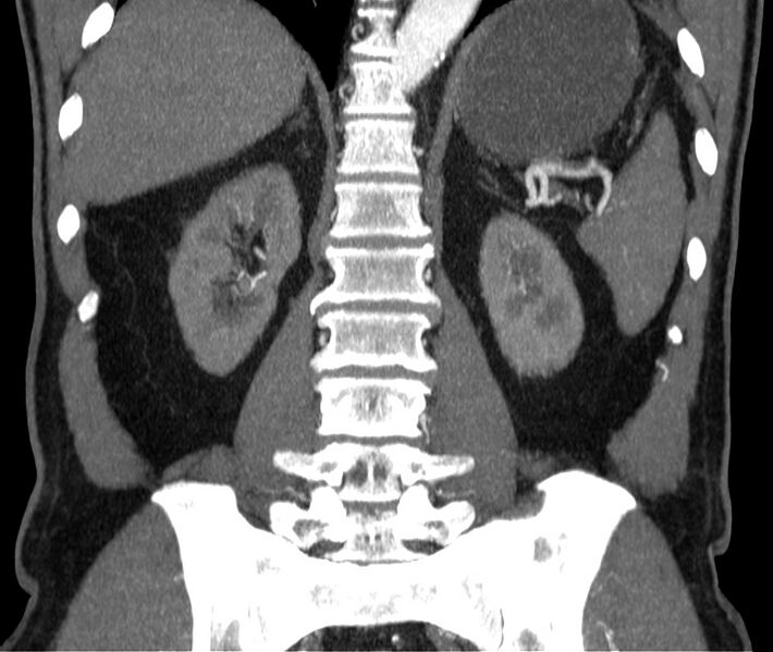 File:Abdominal aortic aneurysm (Radiopaedia 22421-22458 C 32).jpg