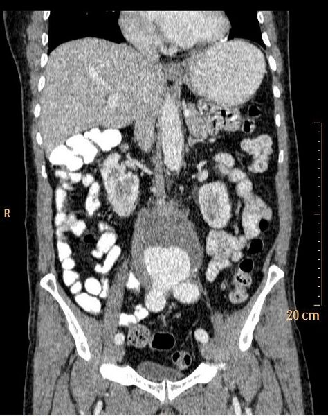 File:Abdominal aortic aneurysm (Radiopaedia 25985-26121 Coronal C+ arterial phase 18).jpg