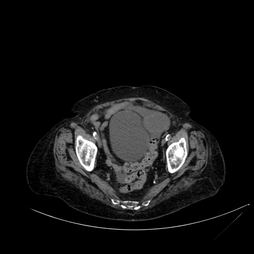 Abdominal aortic aneurysm - impending rupture (Radiopaedia 19233-19246 Axial non-contrast 108).jpg