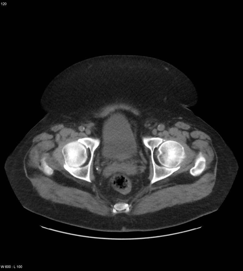 Abdominal aortic aneurysm with intramural hematoma then rupture (Radiopaedia 50278-55631 Axial non-contrast 116).jpg