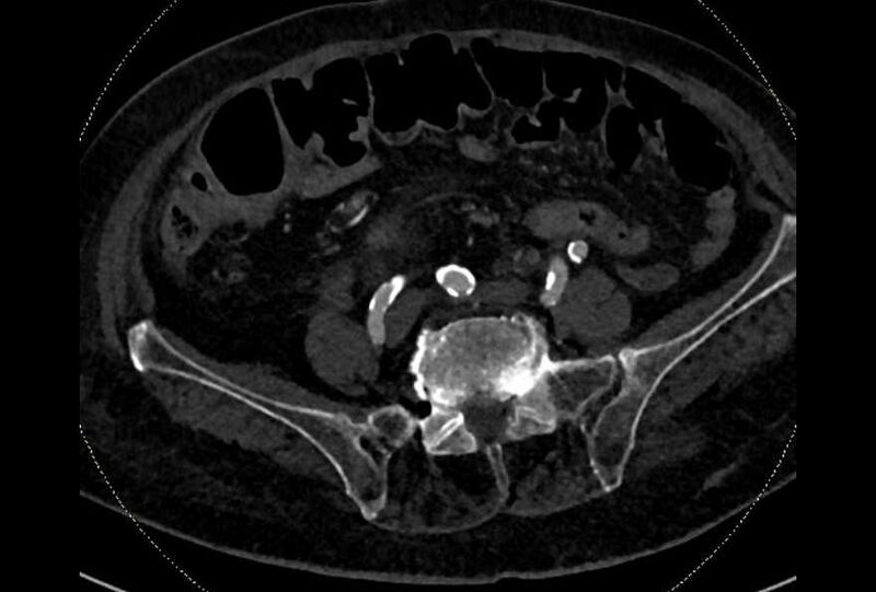 File:Abdominal aortic aneurysm with thrombus fissuration (Radiopaedia 73192-83919 Axial C+ arterial phase 152).jpg