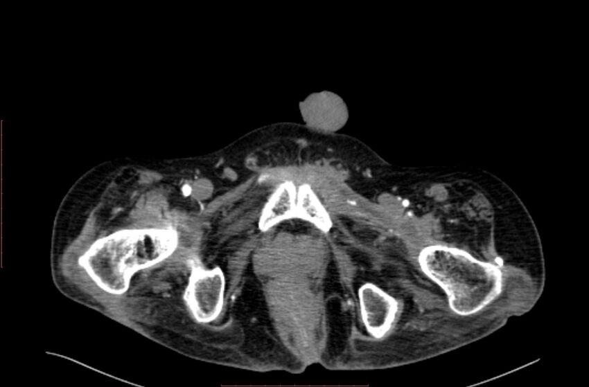 Abdominal aortic interposition tube graft and aneurysm thrombosis (Radiopaedia 71438-81857 Axial C+ arterial phase 253).jpg