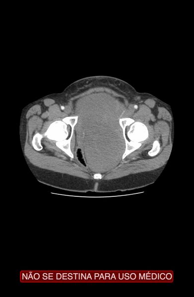File:Abdominal desmoid tumor (Radiopaedia 44024-47540 Axial C+ arterial phase 51).jpg