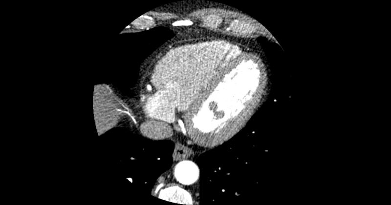 File:Aberrant left main coronary artery (ALMCA) arising from the right sinus with interarterial course (Radiopaedia 63251-71814 Axial C+ arterial phase 155).JPG