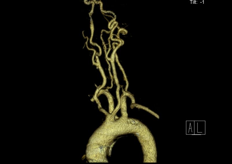 File:Aberrant right subclavian artery (Radiopaedia 19283-19294 3D reconstruction C+ arterial phase 11).jpg