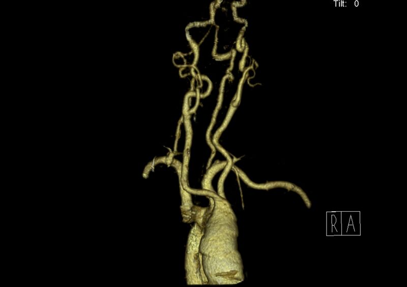File:Aberrant right subclavian artery (Radiopaedia 19283-19294 3D reconstruction C+ arterial phase 3).jpg