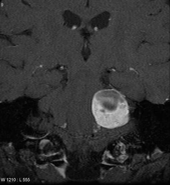File:Acoustic schwannoma (large with cystic change) (Radiopaedia 5369-7130 Coronal T1 C+ fat sat 6).jpg