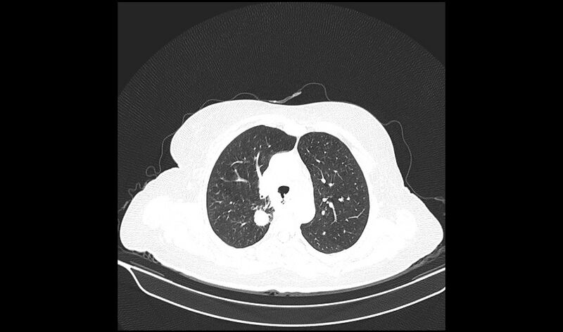 File:Acquired tracheo-esophageal fistula (Radiopaedia 51356-57103 Axial lung window 14).jpg