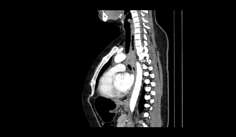File:Acquired tracheo-esophageal fistula (Radiopaedia 51356-57103 Sagittal C+ arterial phase 6).jpg
