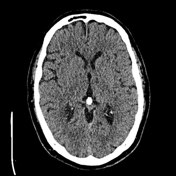 File:Acute A3 occlusion with ACA ischemic penumbra (CT perfusion) (Radiopaedia 72036-82525 Axial non-contrast thins 31).jpg