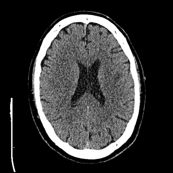 File:Acute A3 occlusion with ACA ischemic penumbra (CT perfusion) (Radiopaedia 72036-82525 Axial non-contrast thins 59).jpg