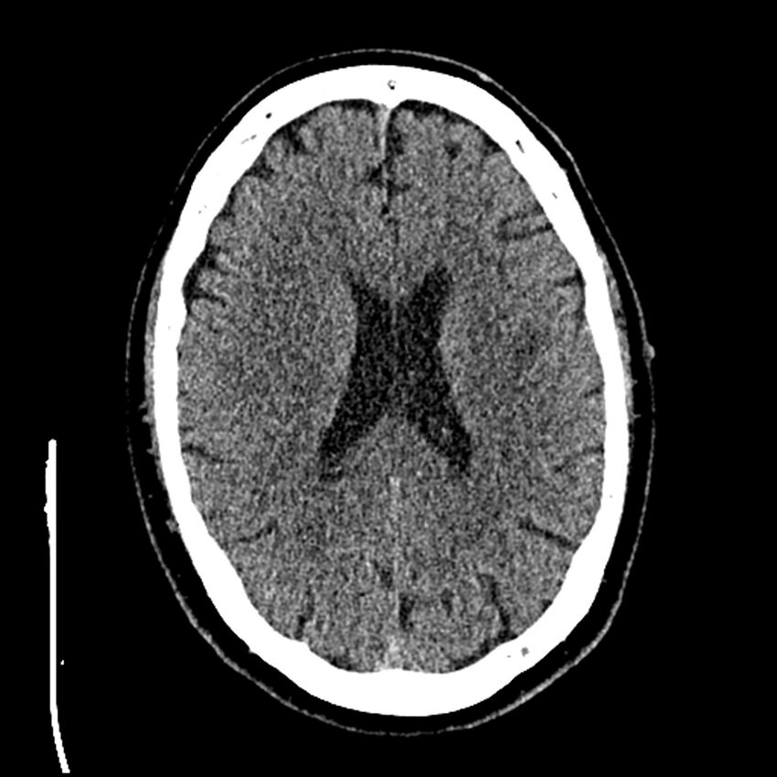 Acute A3 occlusion with ACA ischemic penumbra (CT perfusion) (Radiopaedia 72036-82525 Axial non-contrast thins 59).jpg