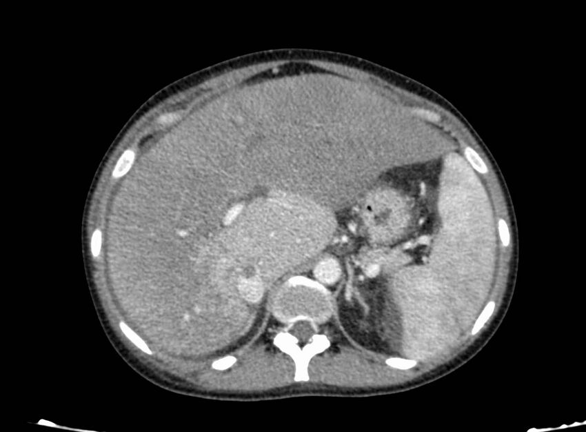 Acute Budd-Chiari syndrome (Radiopaedia 60858-68638 Axial C+ portal venous phase 86).jpg
