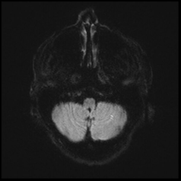 File:Acute P1 occlusion with PCA ischemia penumbra (CT perfusion) (Radiopaedia 72084-82590 Axial DWI 5).jpg