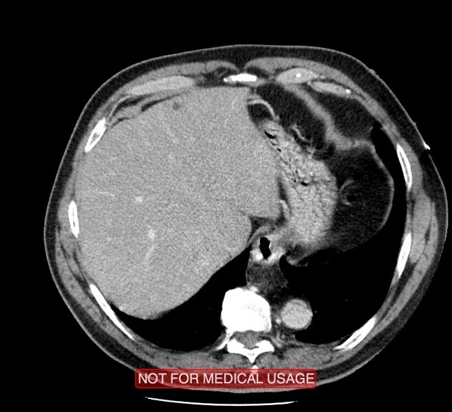 File:Acute aortic dissection - Stanford type A (Radiopaedia 40661-43285 Axial C+ portal venous phase 56).jpg