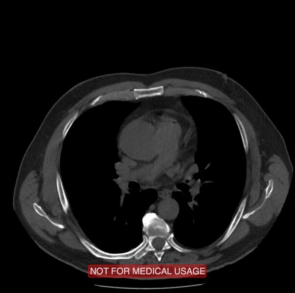 File:Acute aortic dissection - Stanford type A (Radiopaedia 40661-43285 Axial non-contrast 26).jpg