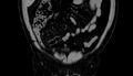 Acute appendicitis (Radiopaedia 13030-13091 Coronal non-contrast 1).jpg